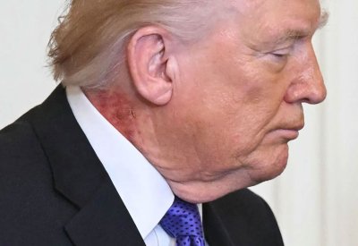 طبيب ترامب: الرئيس يستخدم علاجا وقائيا لطفح جلدي في رقبته