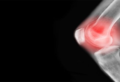 اكتشاف علاج يقلل خطر الإصابة بالتهاب المفاصل الروماتويدي