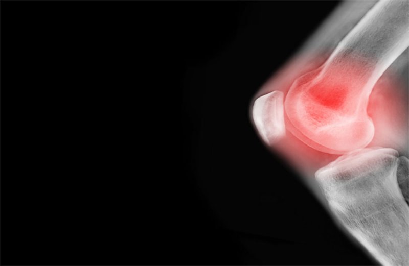 اكتشاف علاج يقلل خطر الإصابة بالتهاب المفاصل الروماتويدي