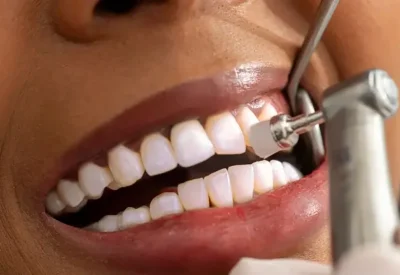 وداعاً للتسوس.. جل جديد يُعيد بناء مينا الأسنان