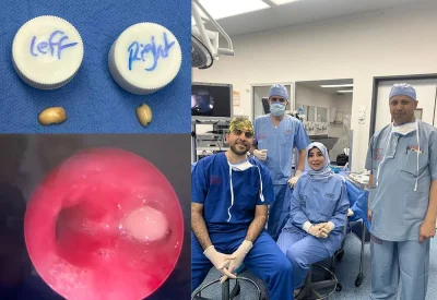 فريق طبي ينقذ طفلا من اختناق خطير بعد دخول قطعتين من المكسرات إلى مجرى التنفس