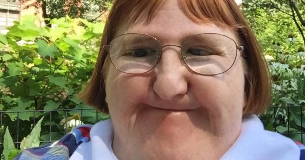 После волны травли за внешность женщина с синдромом Фримана-Шилдона запустила проект ежедневных селфи