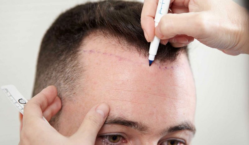 عملية زرع الشعر تودي بحياة أربعيني