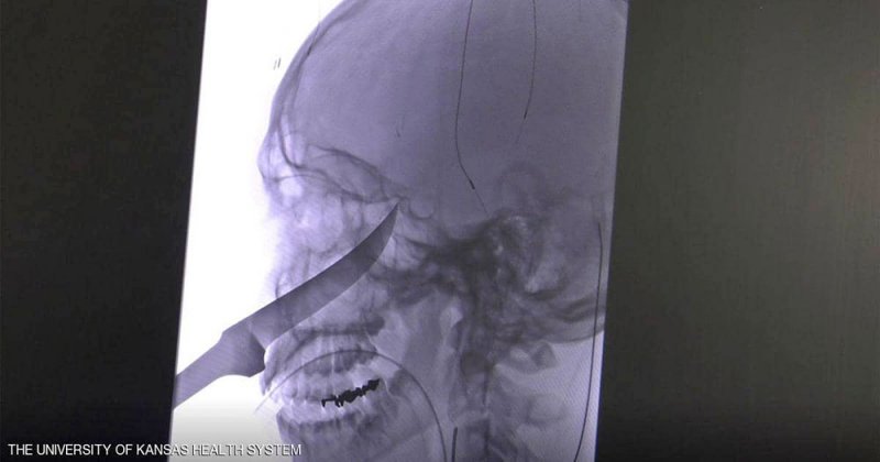 سكين طولها 25 سنتيمترا في جمجمة مراهق
